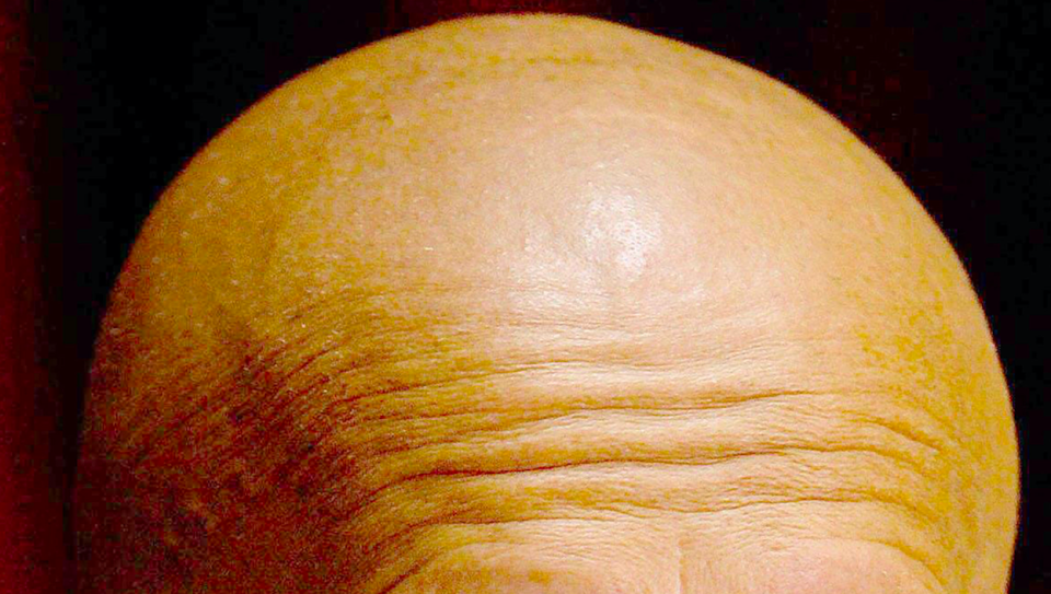 <em>A potential new cure for baldness has been discovered by scientists (PA)</em>