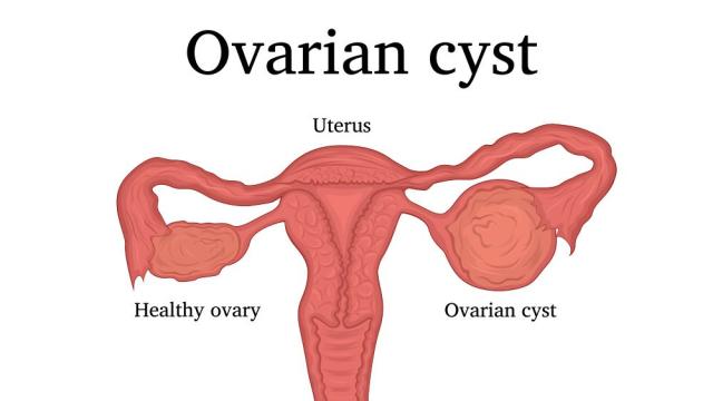 3 Telltale Signs of Problematic Ovarian Cysts: Associates in