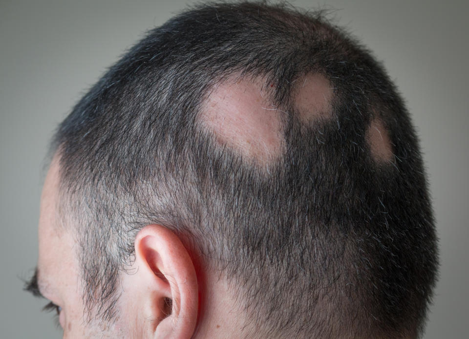 Man suffering from Alopecia areata. (Getty Images)(Getty Images)