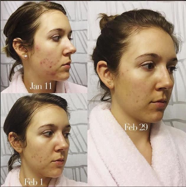 Before and after using Frank original scrub. Photo: Instagram