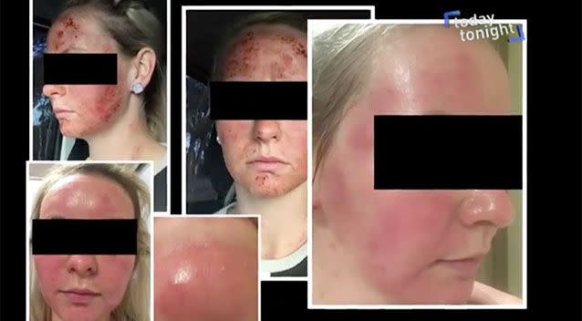 What Nicole's skin looked like after treatment. Source: Today Tonight