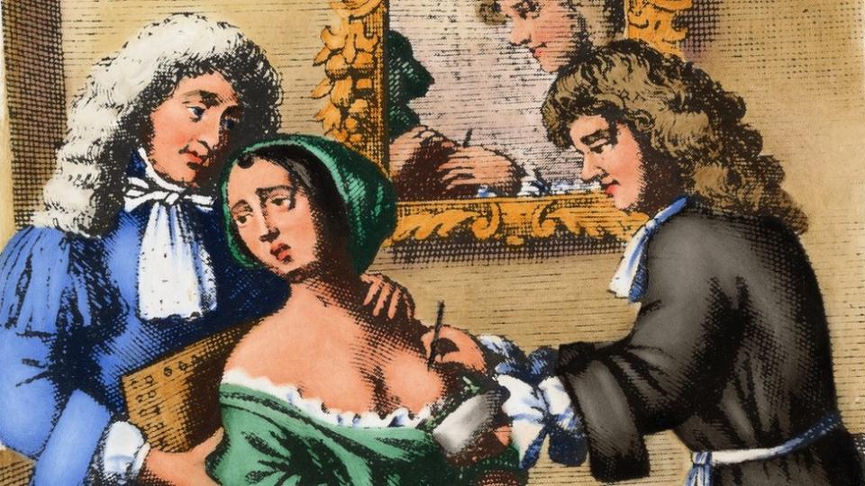 Un cirujano del siglo XVII realiza una mastectomía en una mujer. Londres, 1678.