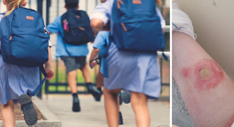 Une maman a publié des photos des brûlures de sa fille pour nous mettre en garde. (Photos: Jamie Prescott via Facebook and Getty Images)