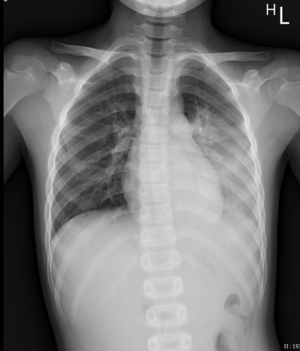 一名八歲男童因呼吸道融合病毒（RSV）合併肺炎鏈球菌及鼻病毒的感染，造成左側大葉性肺炎，胸部X光照片顯示左邊肺部位置幾乎變白了。(花蓮慈濟醫院提供)