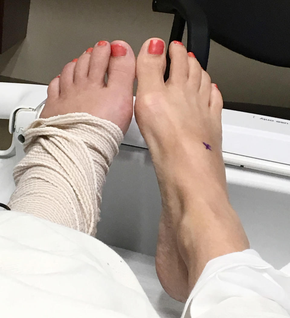 The author still had some mild left foot discoloration after beginning treatment, as seen here. (Sarah Lemire)