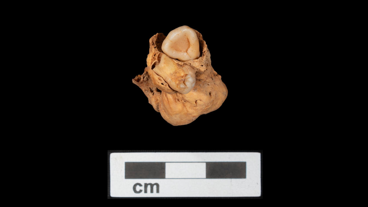  Teratoma with Tooth A (lower) in situ and Tooth B (upper) retrofitted in crypt. 