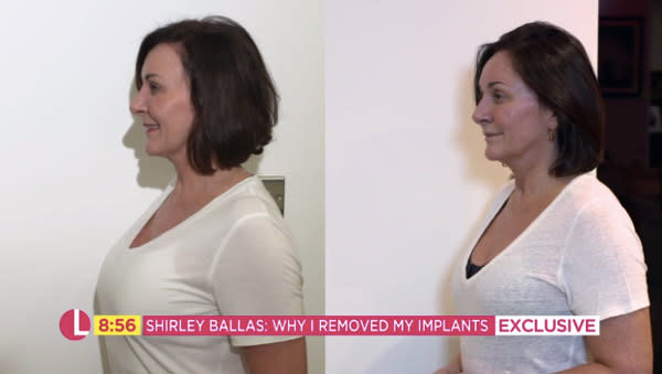 shirley-ballas-surgery