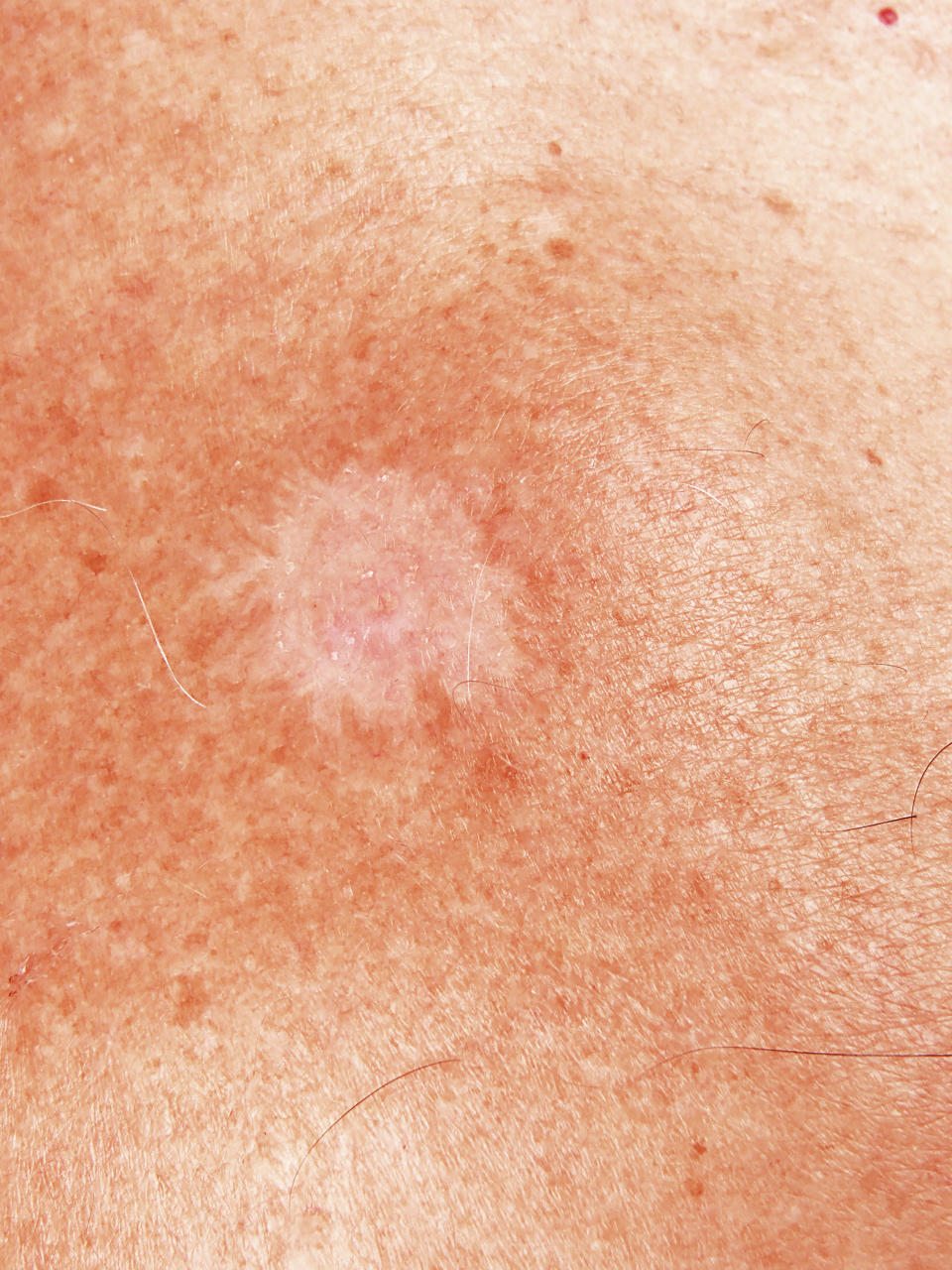 Basal cell carcinoma is the most common form of skin cancer. (Image via Getty Images)