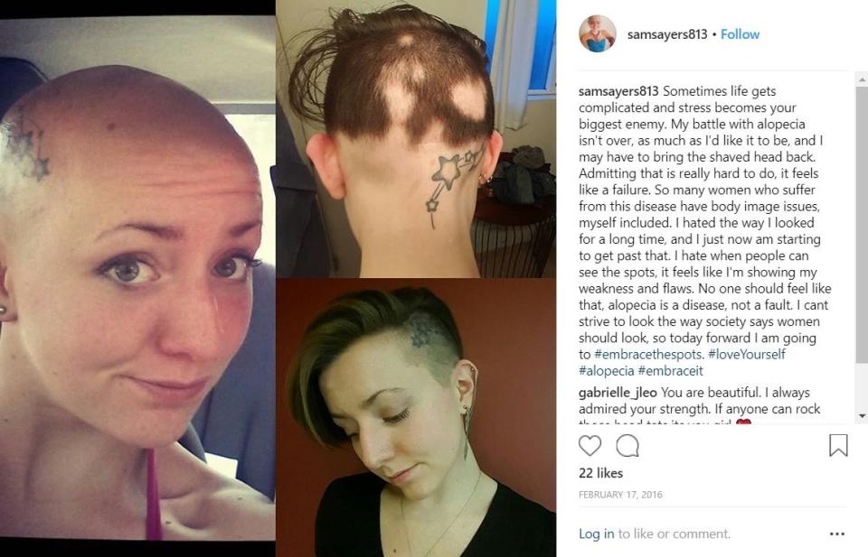 Samantha Sayers grew up in Girard, Pennsylvania, a small borough in the Erie metropolitan statistical area. In high school, she was diagnosed with <a href="https://www.webmd.com/skin-problems-and-treatments/guide/alopecia-areata#1" target="_blank" rel="noopener noreferrer" data-ylk="subsec:paragraph;cpos:9;elm:context_link;itc:0" data-rapid-parsed="slk" data-rapid_p="6" data-v9y="1">alopecia</a>, an incurable autoimmune disorder that attacks hair follicles, causing hair to fall out. (Photo: Instagram)