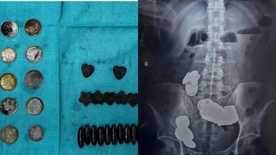 男病患共把39枚硬幣、37塊磁鐵吞下肚，導致連續腹痛20天。（圖／翻攝自「@Delhiite_」X）