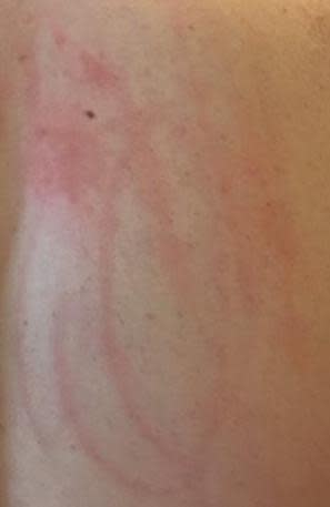 why do i get hives when my dog scratched me
