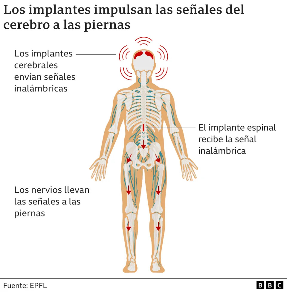 Gr&#xe1;fico muestra la funci&#xf3;n de implantes cerebrales y medulares