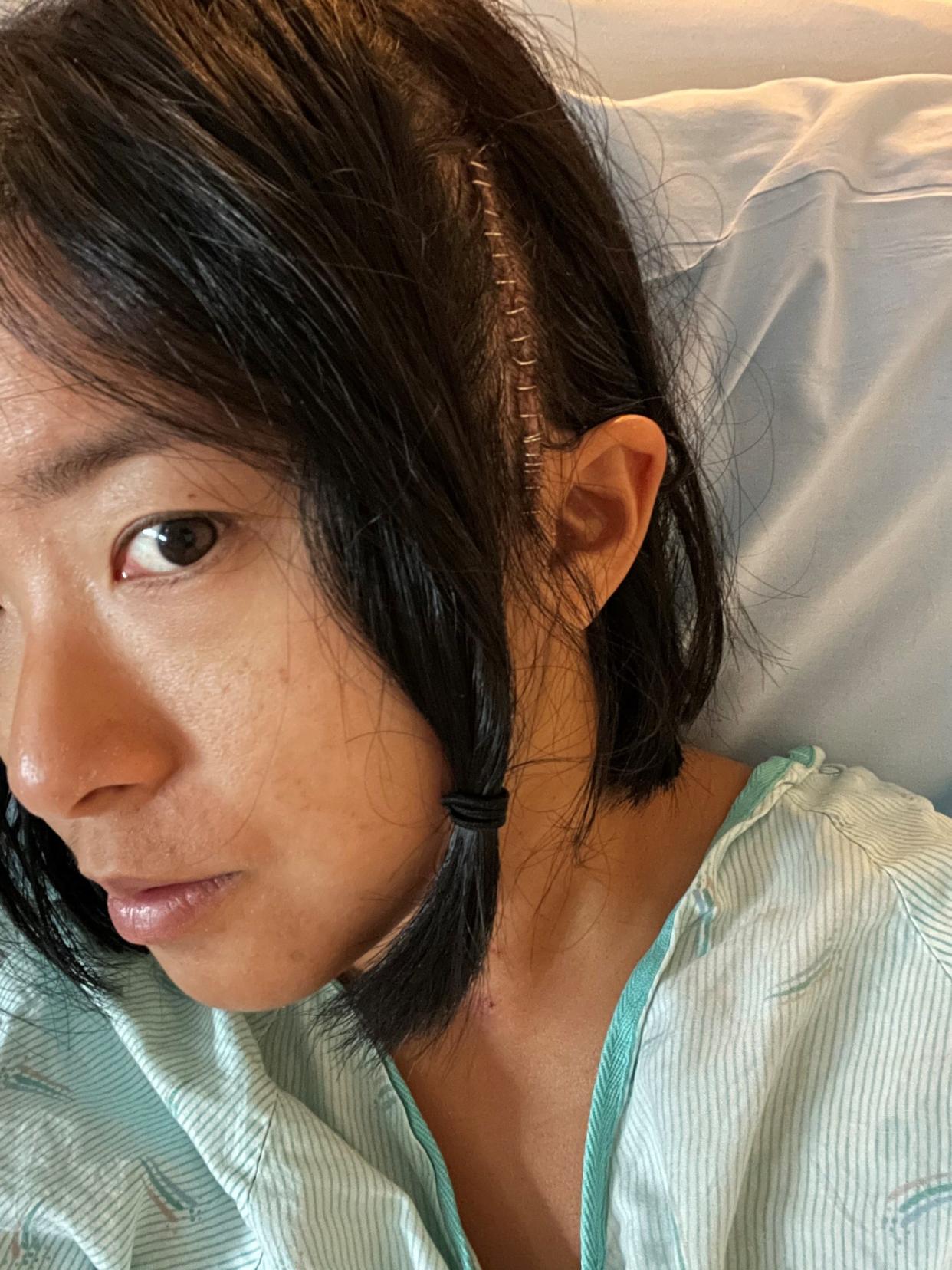 Jia Wu with staples in her head after brain surgery