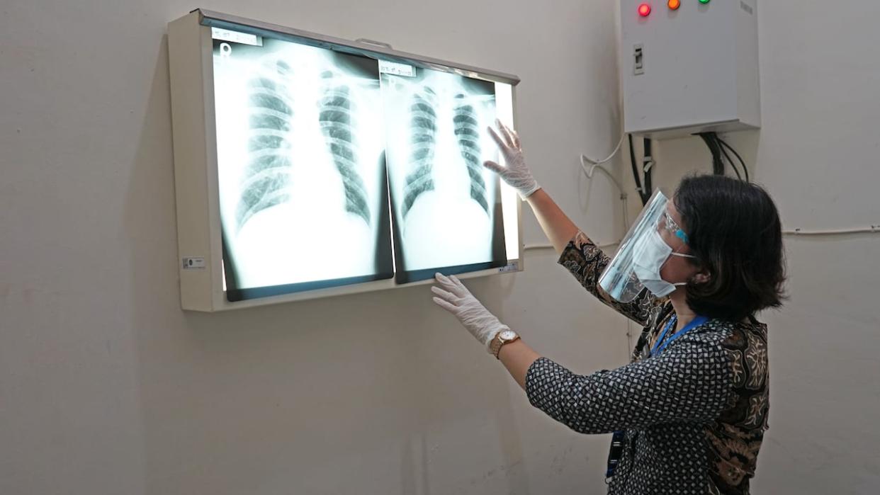A medical worker examines an X-ray of a patient's lungs. Inuit in Canada face tuberculosis rates more than 300 times higher than non-Indigenous, Canadian born people. (Pardi Hutabarat/Shutterstock - image credit)
