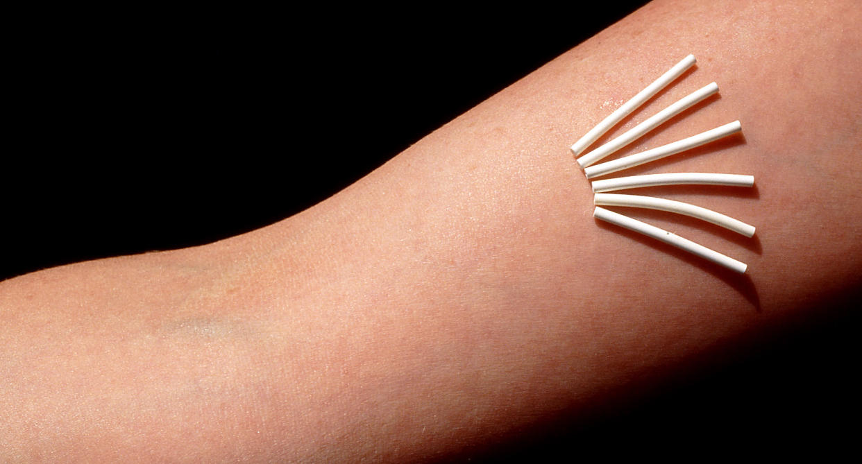 A scale image of multiple birth control implants. One 4 cm device is implanted into a woman's arm as an alternative form of contraception. Image via Getty Images. 