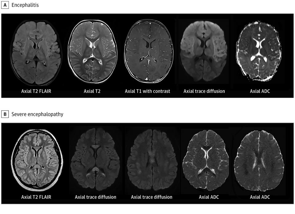 Una fotografía proporcionada por LaRovere et al., JAMA Neurolology 2021 muestra, en la parte superior, tomografías computarizadas del cerebro de un niño que estaba sano antes de contraer el síndrome inflamatorio multisistémico en niños; y, en la parte inferior, las de un niño en edad escolar con el padecimiento. Las imágenes fueron tomadas de un estudio publicado el mes pasado en JAMA Neurolology. (LaRovere et al., JAMA Neurolology 2021 vía The New York Times)