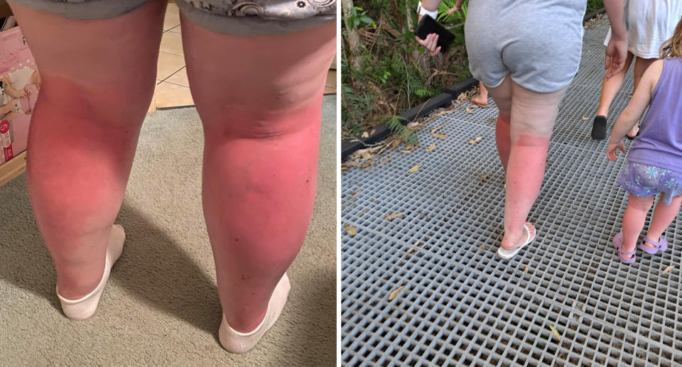 The backs of the women's legs were left a bright red after the day at the beach. Source: Supplied