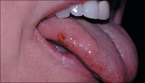 Cheek bite or tongue bite