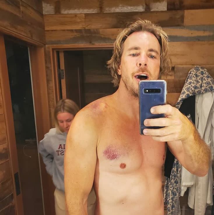 Dax Shepard didn’t let a few broken ribs stop him from snapping a post-motorcycle accident selfie. The actor and “Armchair Expert” podcaster showed off from scars from a recent accident he got in while riding his motorcycle; he broke four ribs total. “Thank you Armcherries for all the well wishes and concern. I'm in one piece and spirits are high :) Sorry for causing concern.”