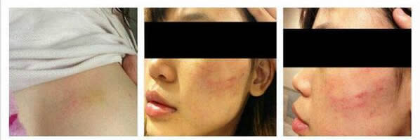 Photos of a bruised up Luna Aphroditee surfaced on news blog The Real Singapore. (Online screengrab)