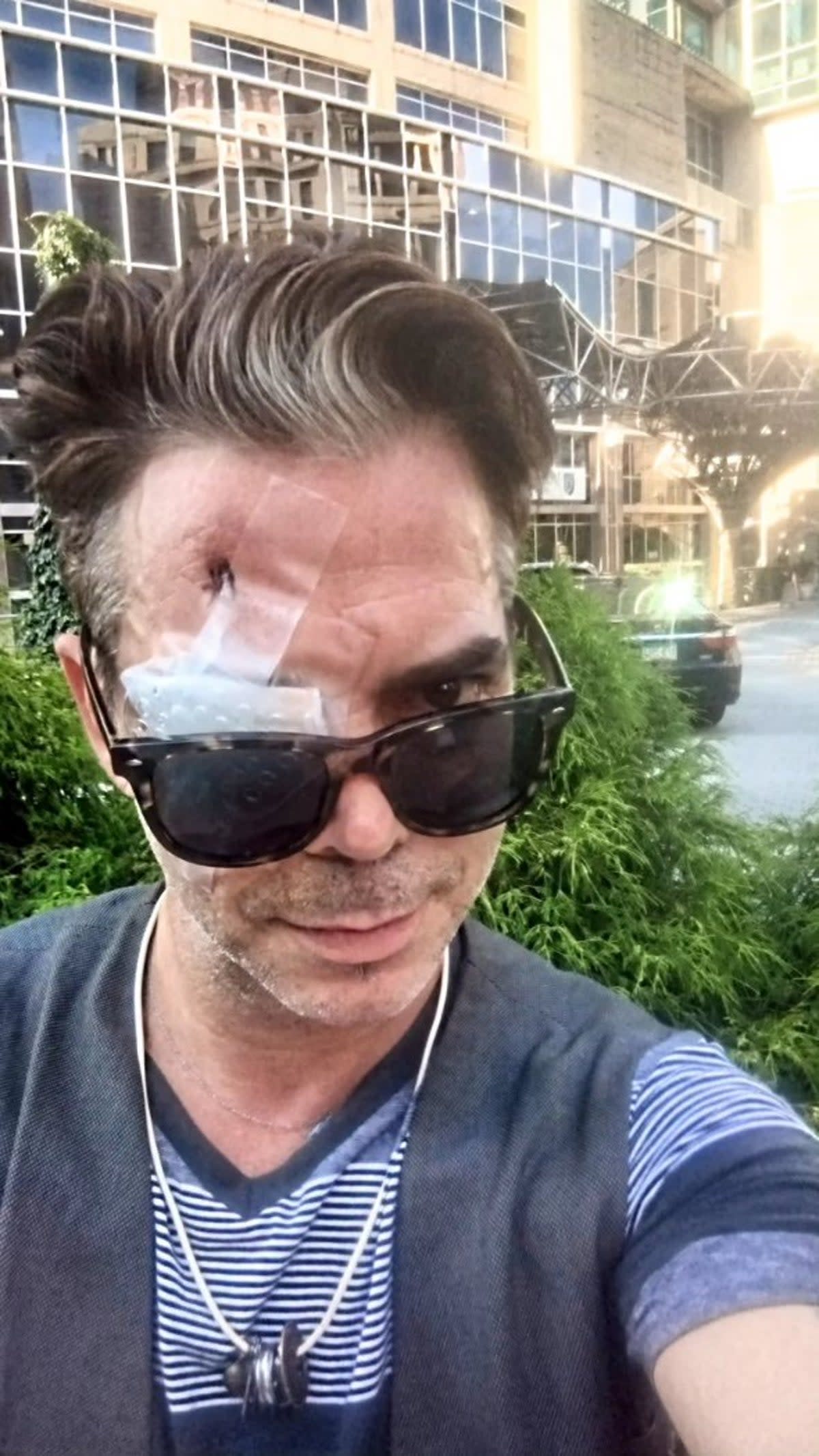 Will Keenan reveals his bandaged left eye, which was blinded after someone attacked him for wearing a Covid-19 mask (Will Keenan / X)