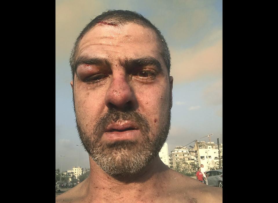 Nabih Bulos was injured in the Beirut explosion