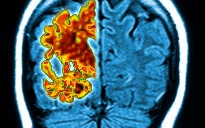 An Alzheimer's brain (left) compared with a healthy brain - PASIEKA