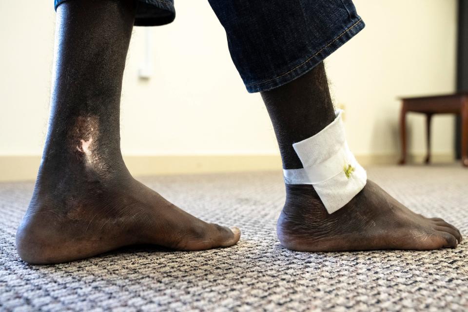 A 34-year-old Mauritanian man seeking asylum shows scars and a wound around his ankle that is still healing. It was inflicted when he was  bound by rope and chains while enslaved in his country.