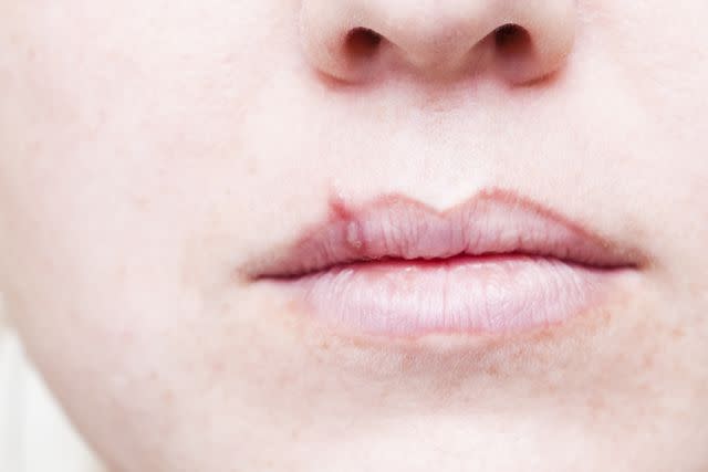 Todd Keith/E+/Getty Images Cold sore on lip