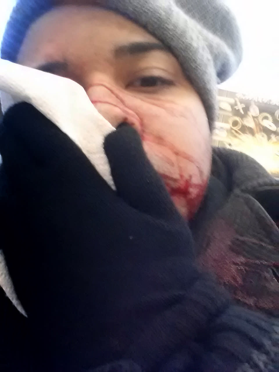 In this Jan 22, 2014 photo provided by Barry Negron, Negron holds a tissue to his face after being struck by ice falling off a four story building in New York. He required 8o stitches after getting hit in the face with a sharp, football-size chunk of ice while trying to warn other pedestrians about the potential of falling ice. City dwellers battling one of the most brutal winters on record have been dealing with something far more dangerous than snow falling from the sky: ice tumbling from skyscrapers. (AP Photo/Barry Negron)