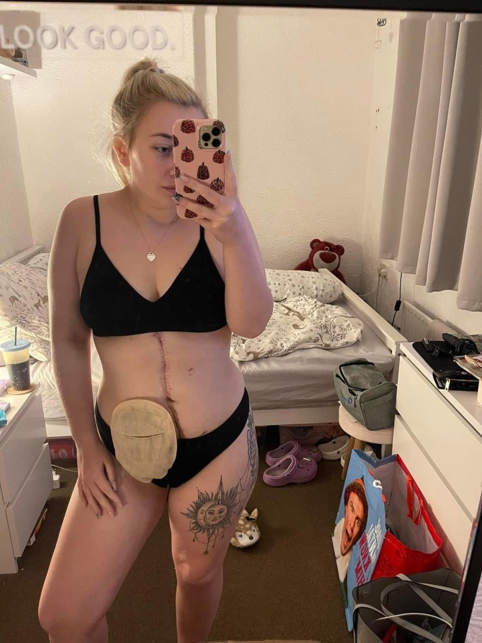 Emma had a temporary stoma while undergoing treatment (Supplied)