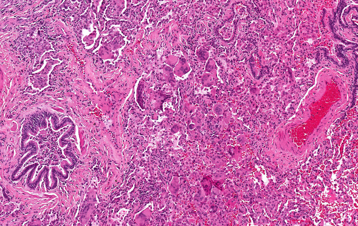 Cobalt lung (Photo: University of California San Francisco)