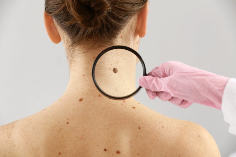<span class="caption">Not only the number but also the location of moles on the body is in large part due to genetics.</span> <span class="attribution"><a class="link " href="https://www.shutterstock.com/image-photo/dermatologist-examining-moles-patient-on-light-1370971718?src=Tq_P3by7JBwA2jiJLYyKhg-1-35" rel="nofollow noopener" target="_blank" data-ylk="slk:Pixel-Shot/Shutterstock;elm:context_link;itc:0;sec:content-canvas">Pixel-Shot/Shutterstock</a></span>