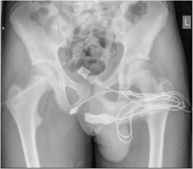 The cable became stuck in the teen's urethra. Source: Urology Case Reports 