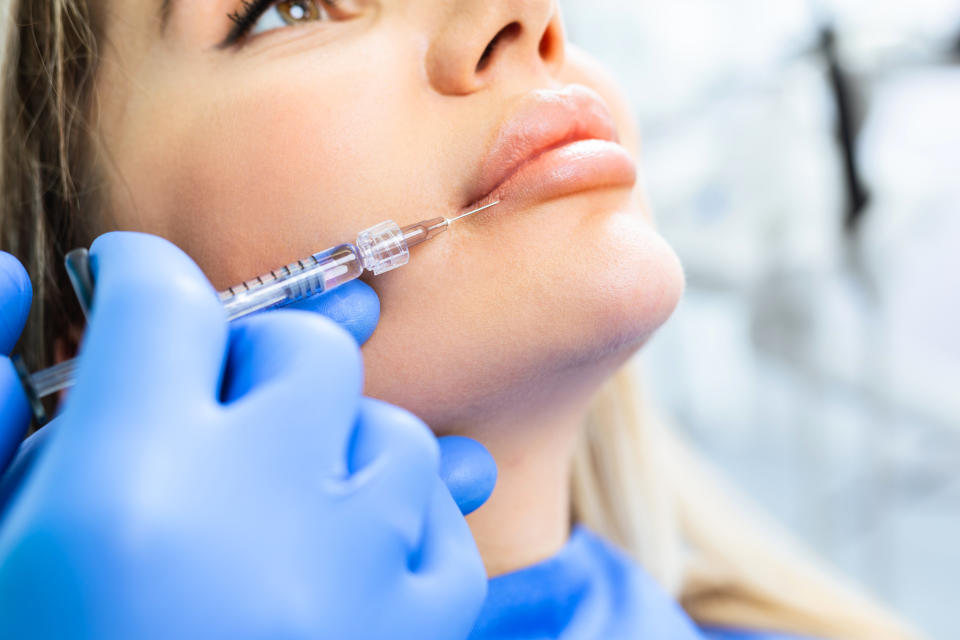 Excess lip filler can migrate around the lips if too much is injected. (Photo: Group4 Studio via Getty Images)