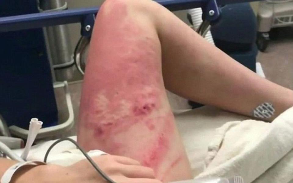 Her injuries included confronting markings on her thighs. Source: KATU 2