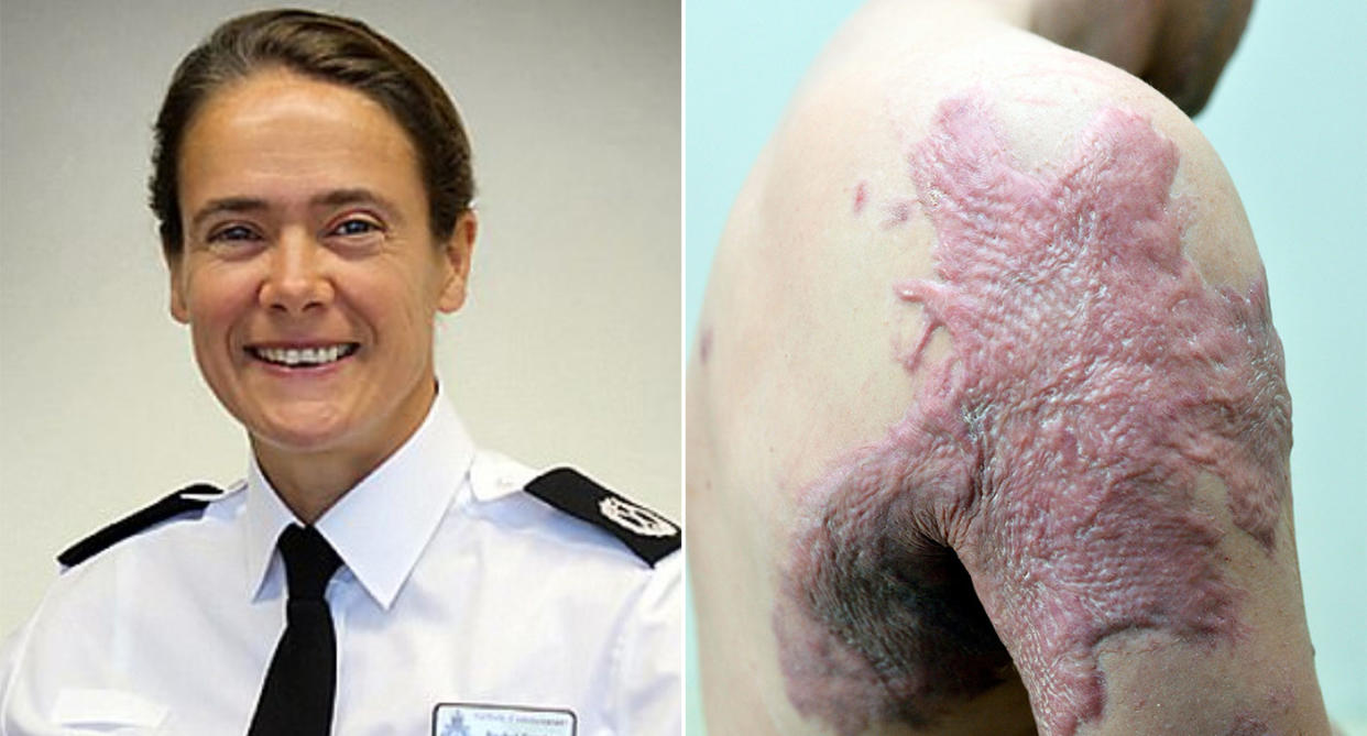 Rachel Kearton, Assistant Chief Constable of Suffolk Police, left, and an acid attack victim (Police.uk/SWNS)