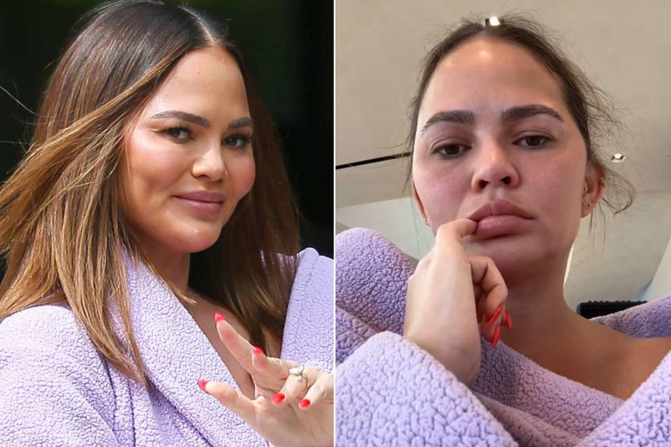 <p>Bellocqimages/Bauer-Griffin/GC Images; Chrissy Teigen/Instagram</p> Chrissy Teigen shares video of herself with double ear infection.