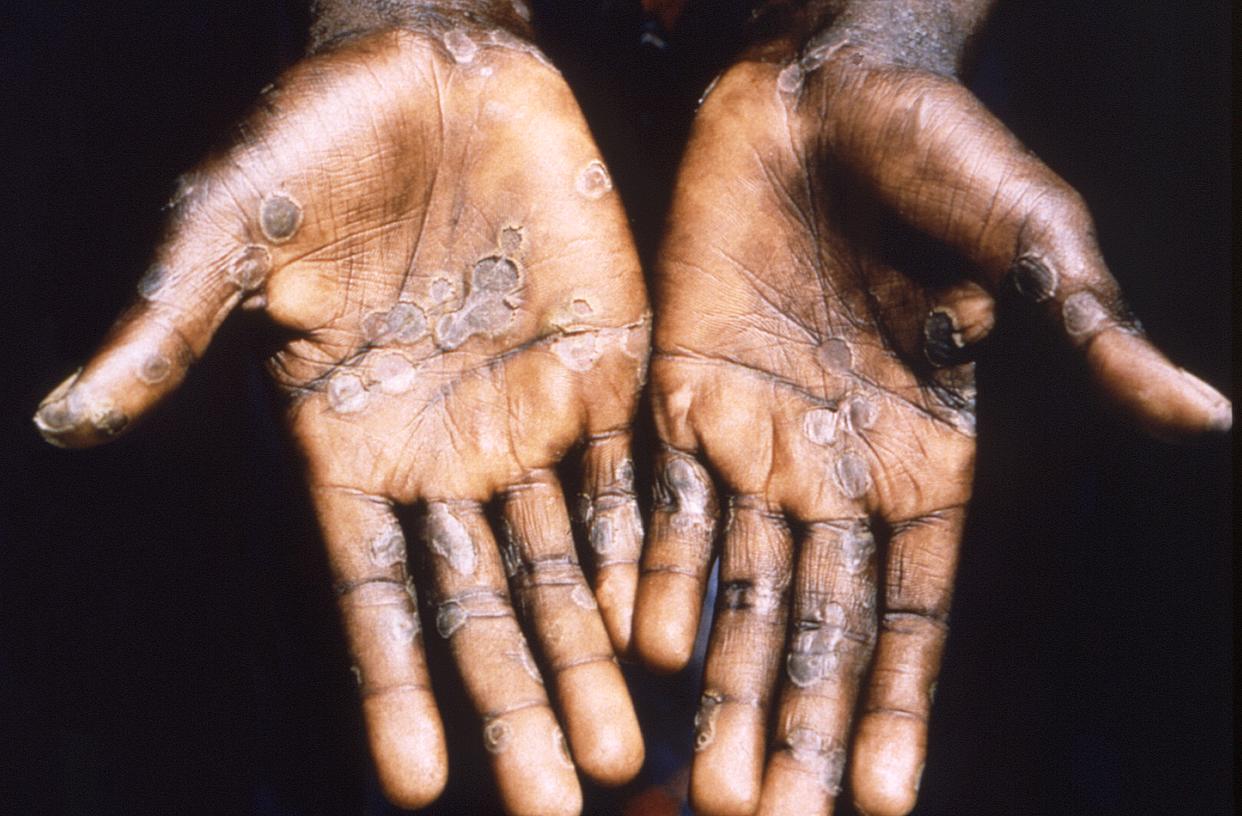 Close-up of a patient's hands showing lesions from the monkeypox virus. 