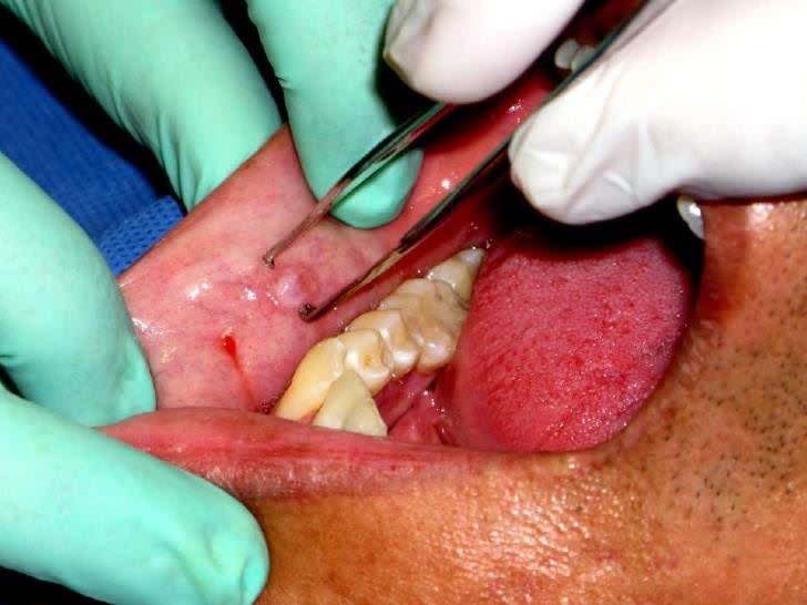 黏液囊腫是口腔內常見的小唾液腺體疾病，常發生在下唇。(圖/臺北市立聯合醫院提供)