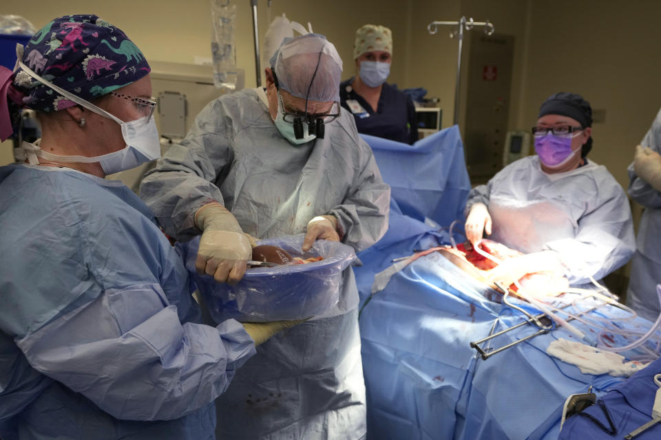 Dr. Marty Sellers hands the liver of an organ donor to LPN scrub nurse Ashton Conrad, left, on June 15, 2023, in Jackson, Tenn. Cancer was later found in the donor’s lungs so the liver couldn’t be used for transplant. (AP Photo/Mark Humphrey)