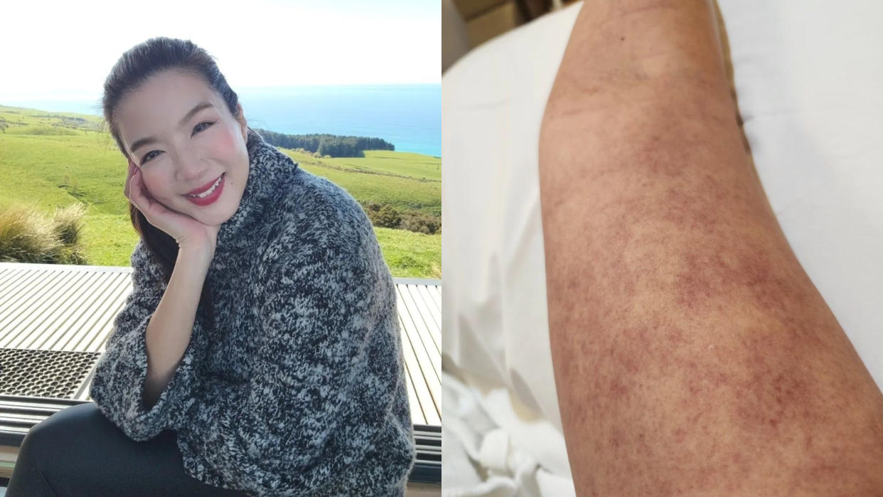 Rui En developed deep vein thrombosis last Friday and rushed to the A&E. (PHOTO: Instagram/wilderseas29)