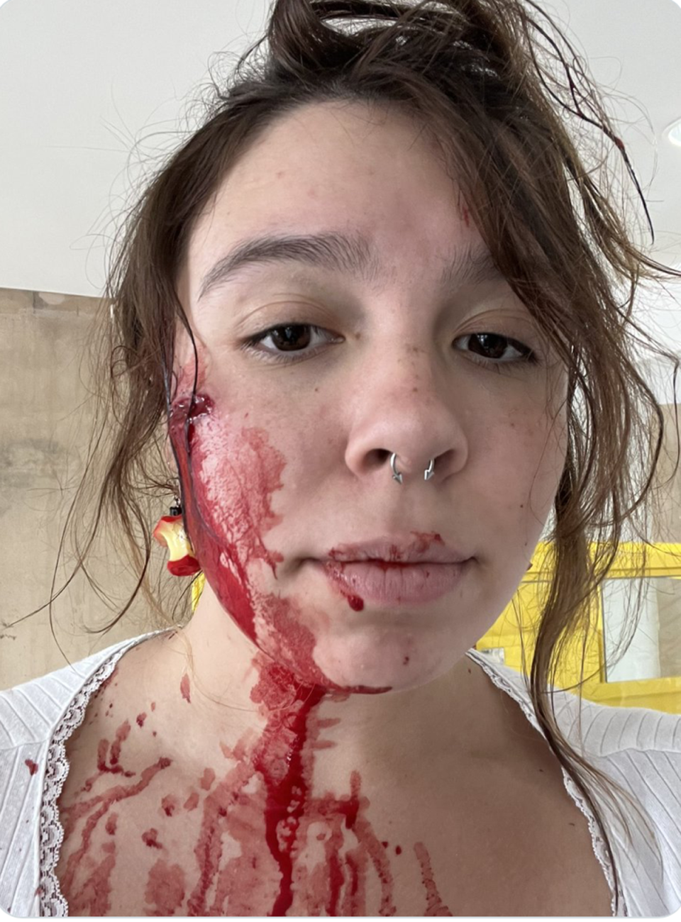 A young woman known as Lilli shared photographs of her injuries sustained in the Highland Park mass shooting (Twitter)