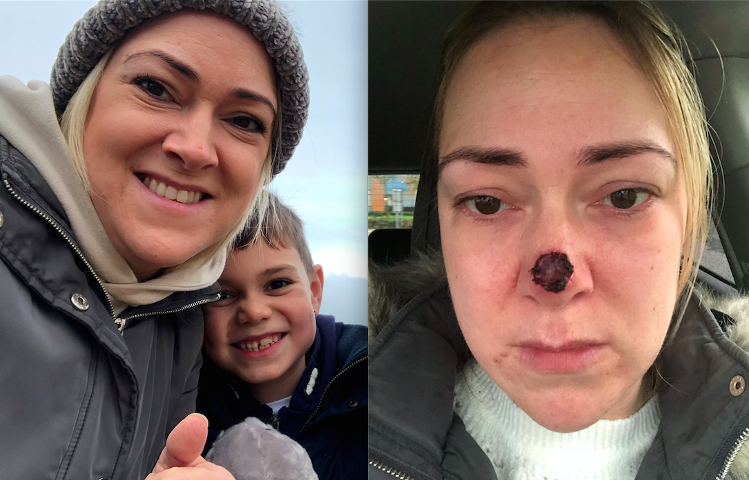 A mum was shocked to discover the spot on the end of her nose was skin cancer [Photo: SWNS]