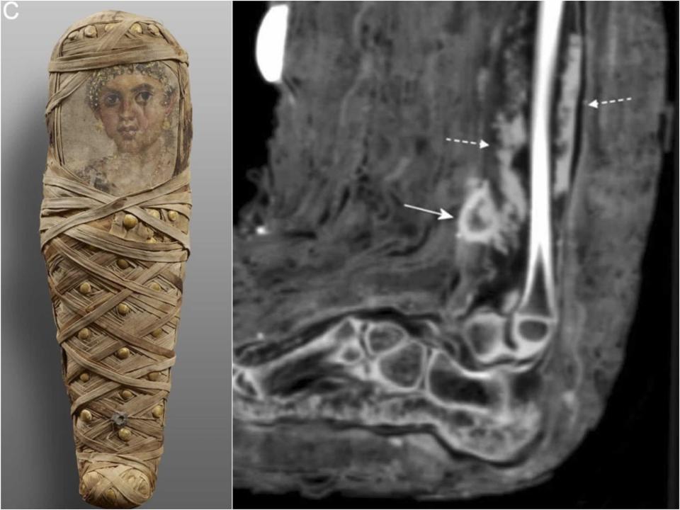 A picture of the mummy is shown next to a scan of the mummy's foot, uncovering the bandage around its leg.