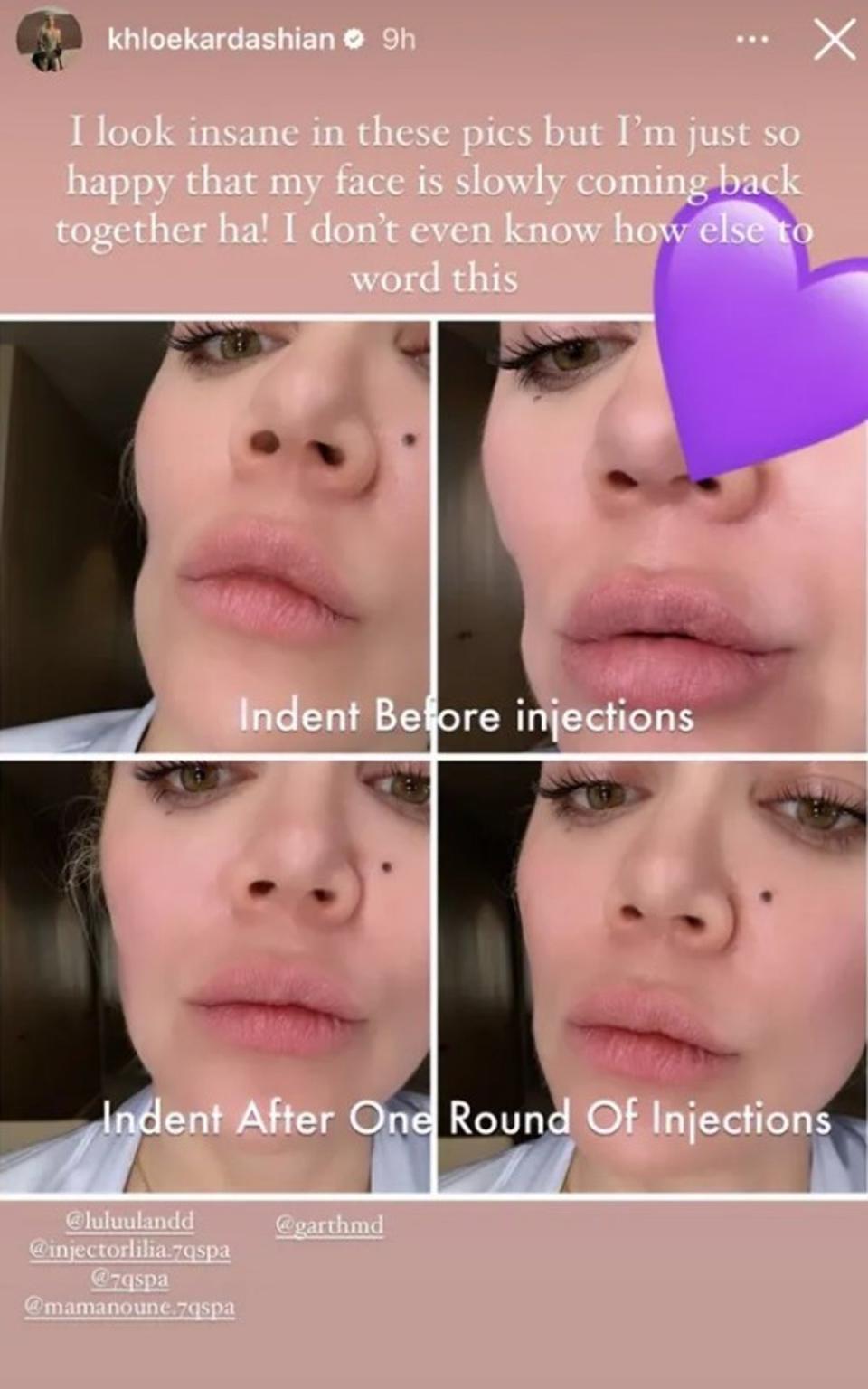 The star has had the indention left behind on her cheek filled (Instagram/Khloe Kardashian)