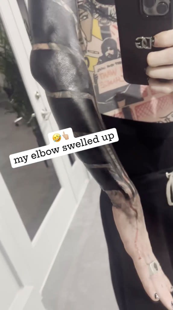 His elbow also swelled from the sessions. Machine Gun Kelly/Instagram