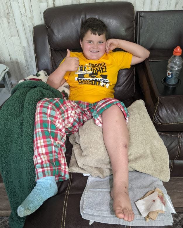 Easton Burchett is recovering at his Banks County home following an attack by a rabid bobcat last weekend.