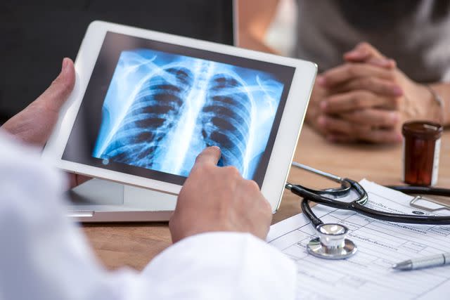 <p>Getty</p> Tuberculosis generally affects the lungs.