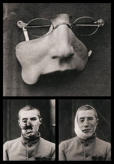 Prótesis facial de la Primera Guerra Mundial, 1916. (Crédito imagen: Biblioteca del Congreso).